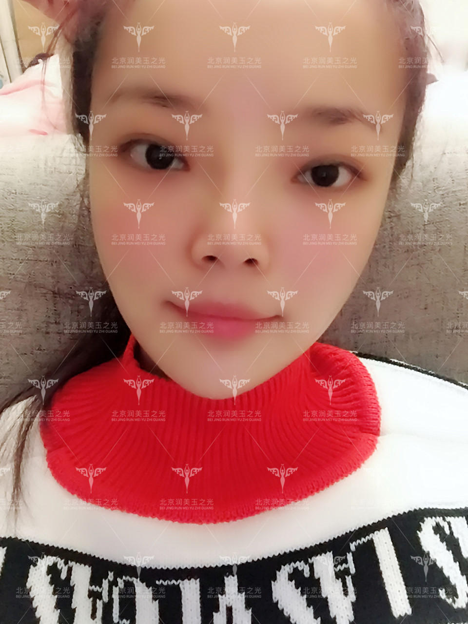脂肪填充脸部过程需要住院吗_脸部填充脂肪后悔死了_脂肪填充全脸费用