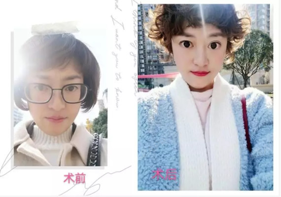 首页 此页面仅支持预览 Avatar 马明 51篇日记 一天8小时看电脑的我 做了icl晶体植入术你好 高清世界 没有夸张 作为一个高度近视的患者 我现在很开心来分享我做完icl晶体植入手术后的感想 普瑞摘镜体验官 藏族女孩松松术前度数 右眼1050度