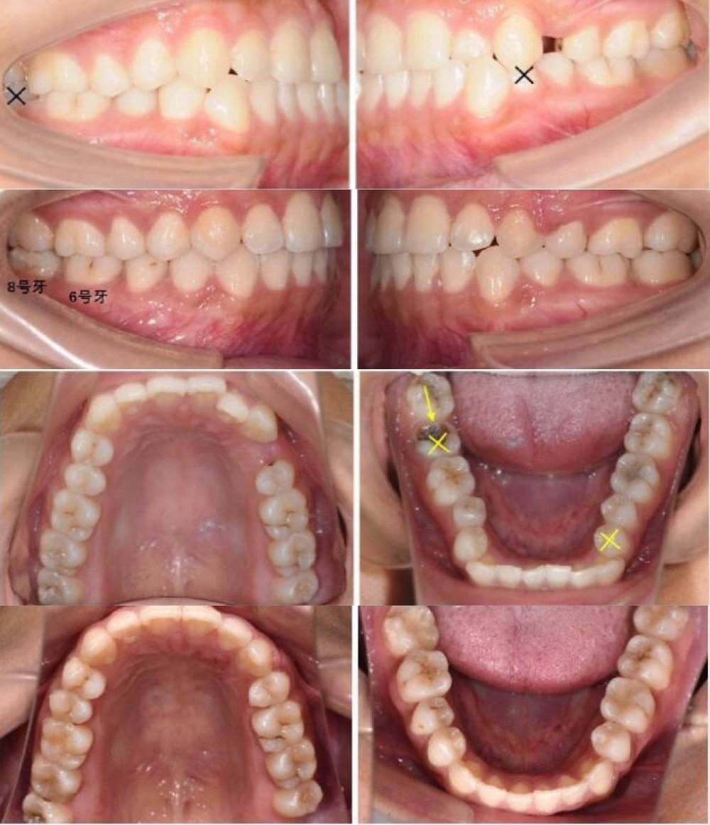 陶瓷自锁:智齿牵引替代磨牙#深圳世纪河山口腔真人案_圈子-新氧美容