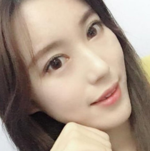 假体隆鼻日记分享术后20天