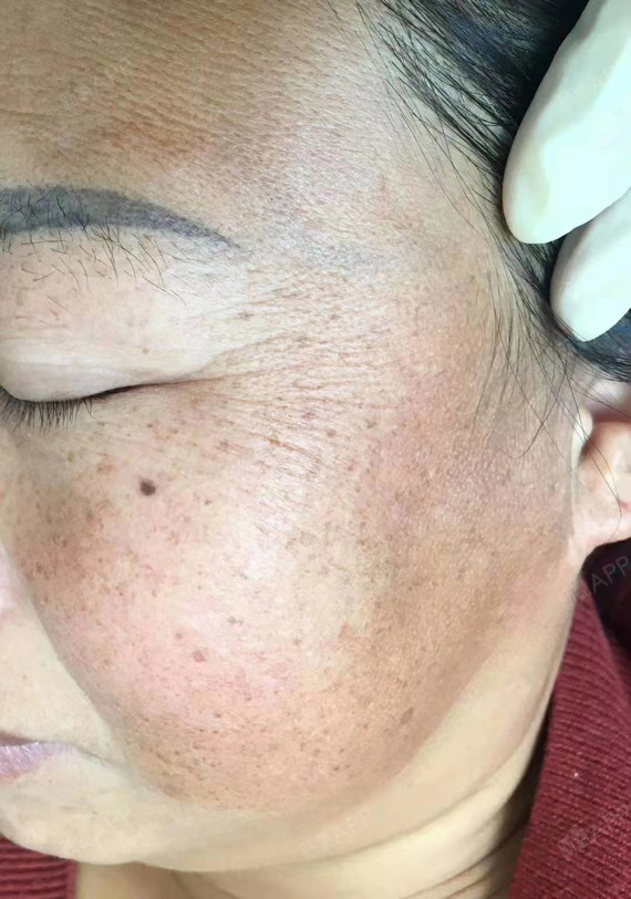 皮秒我的检测出来说是混合斑,有点类似黄褐斑这种,_圈子-新氧美容