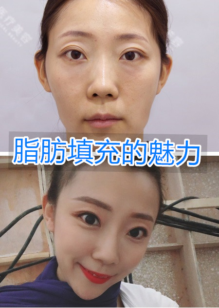 平时拍照很不上镜,想通过自体脂肪填充改善.