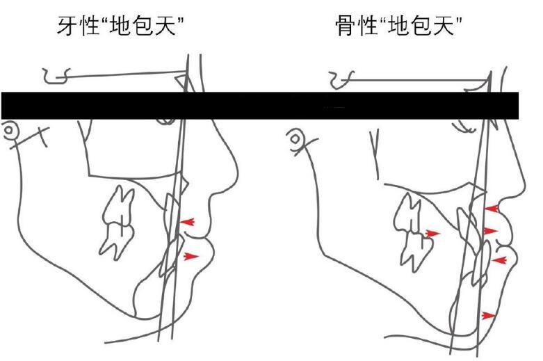 反颌咬撬法图片