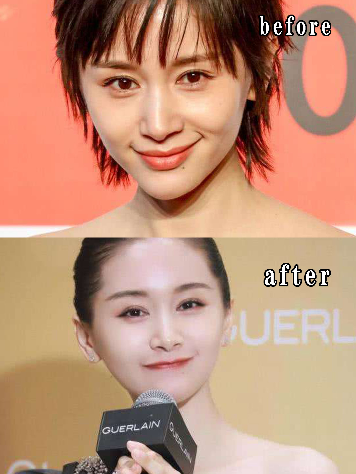 自体脂肪面部填充,明星也有翻车情况,为什么同样是做脂肪填充,王子文