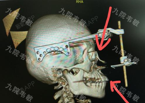 被马蹄踢中了面部,导致鼻骨,上颌骨骨折的男孩诊治最新进展