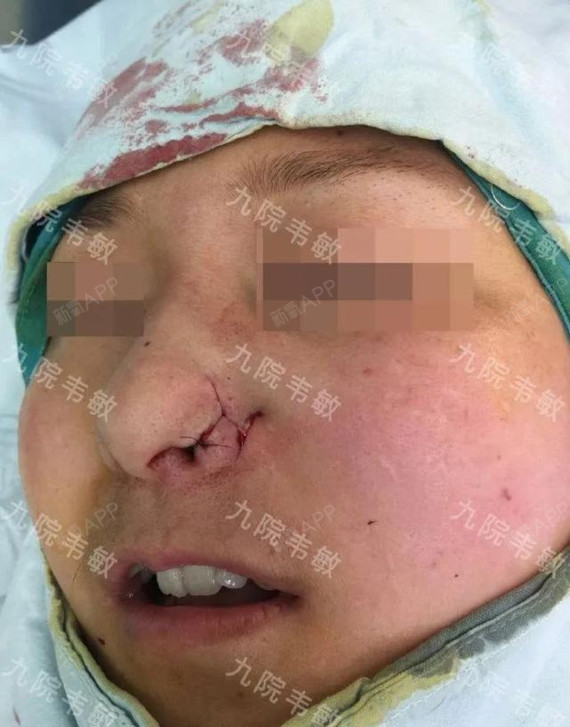 鼻翼缺损怎么办?如何修复?修复难吗?
