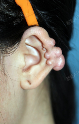 耳朵上的这个疤痕疙瘩一直都是我的心头病,大夏天散着_圈子-新氧美容