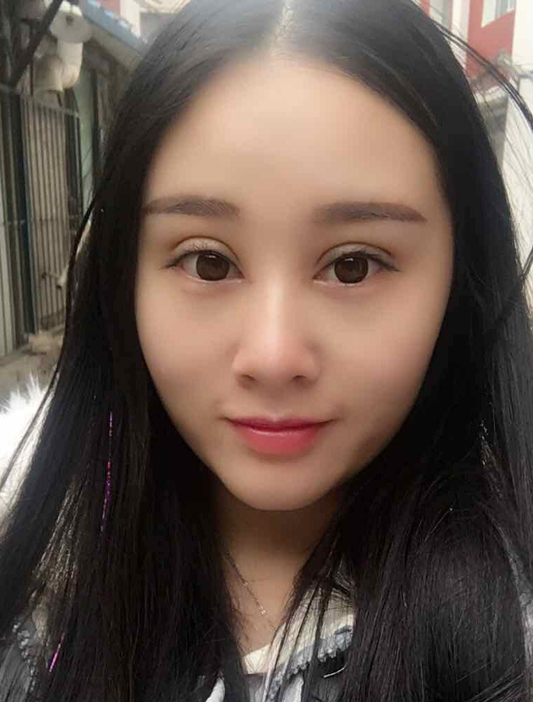 【割双眼皮30天】做了双眼皮,每天心情美美哒,人也_圈子-新氧美容整形