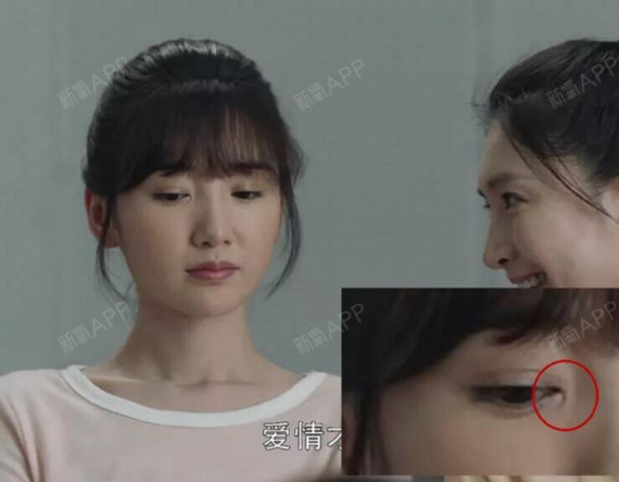 毛晓彤眼角这是疤痕还是内眦赘皮?