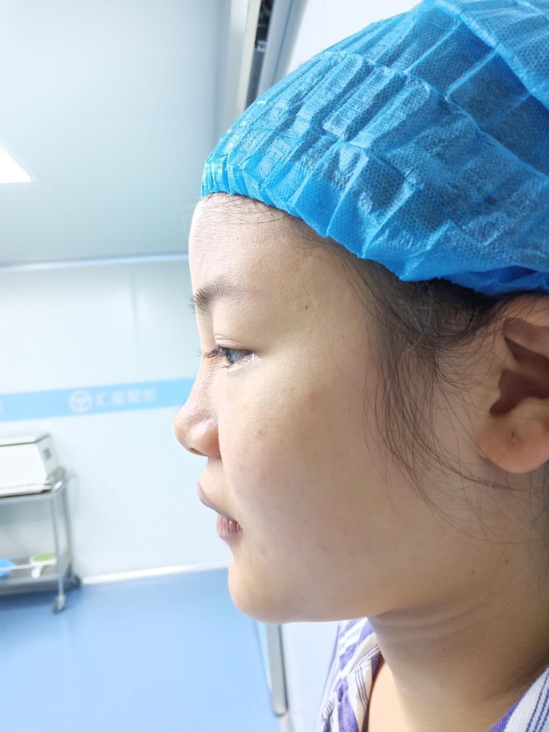 76 宝宝原来的鼻子长度不够,鼻梁扁平,鼻头圆钝,鼻_圈子-新氧美容