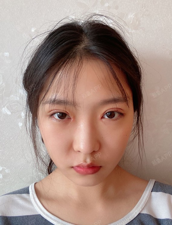 我每天早晚坚持使用祛疤膏 一定会慢慢好起来的  期待满月的双眼皮 就