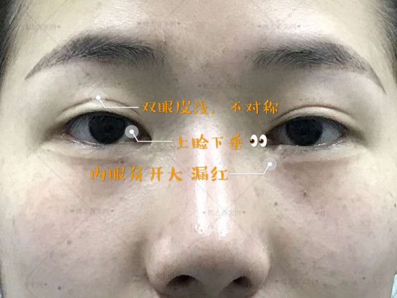 内眼角开大露红肉组织缺损可以修复吗