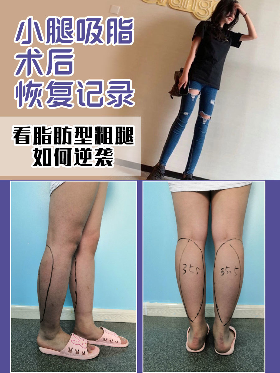 小腿吸脂术后恢复记录,看脂肪型粗腿如何逆袭