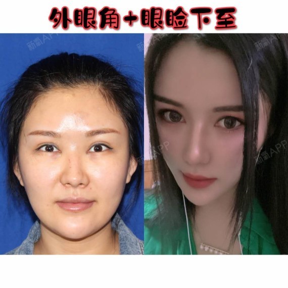 开内眼角和开外眼角,哪个效果好?