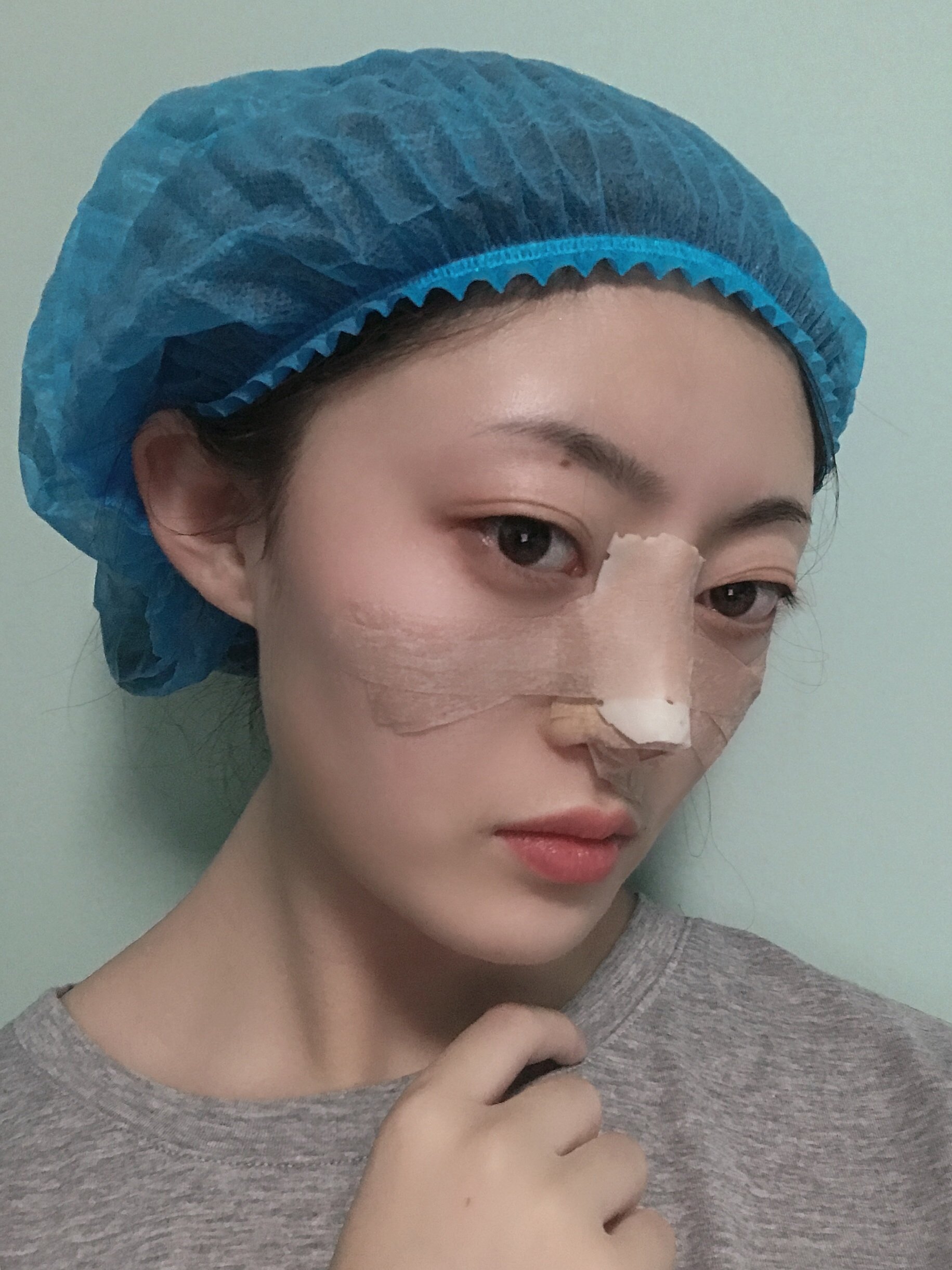 铭医日系轻氧鼻术后