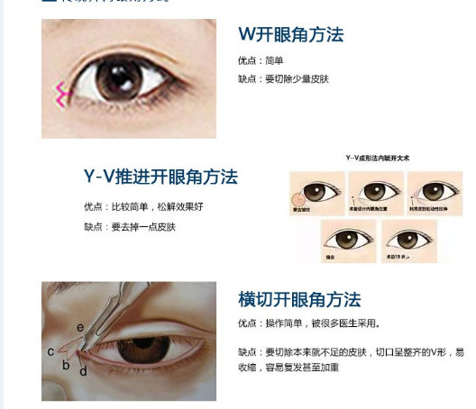 除了医生技术之外,传统的开内眼角手术 v-y,z型开内眼角,容易留下明显
