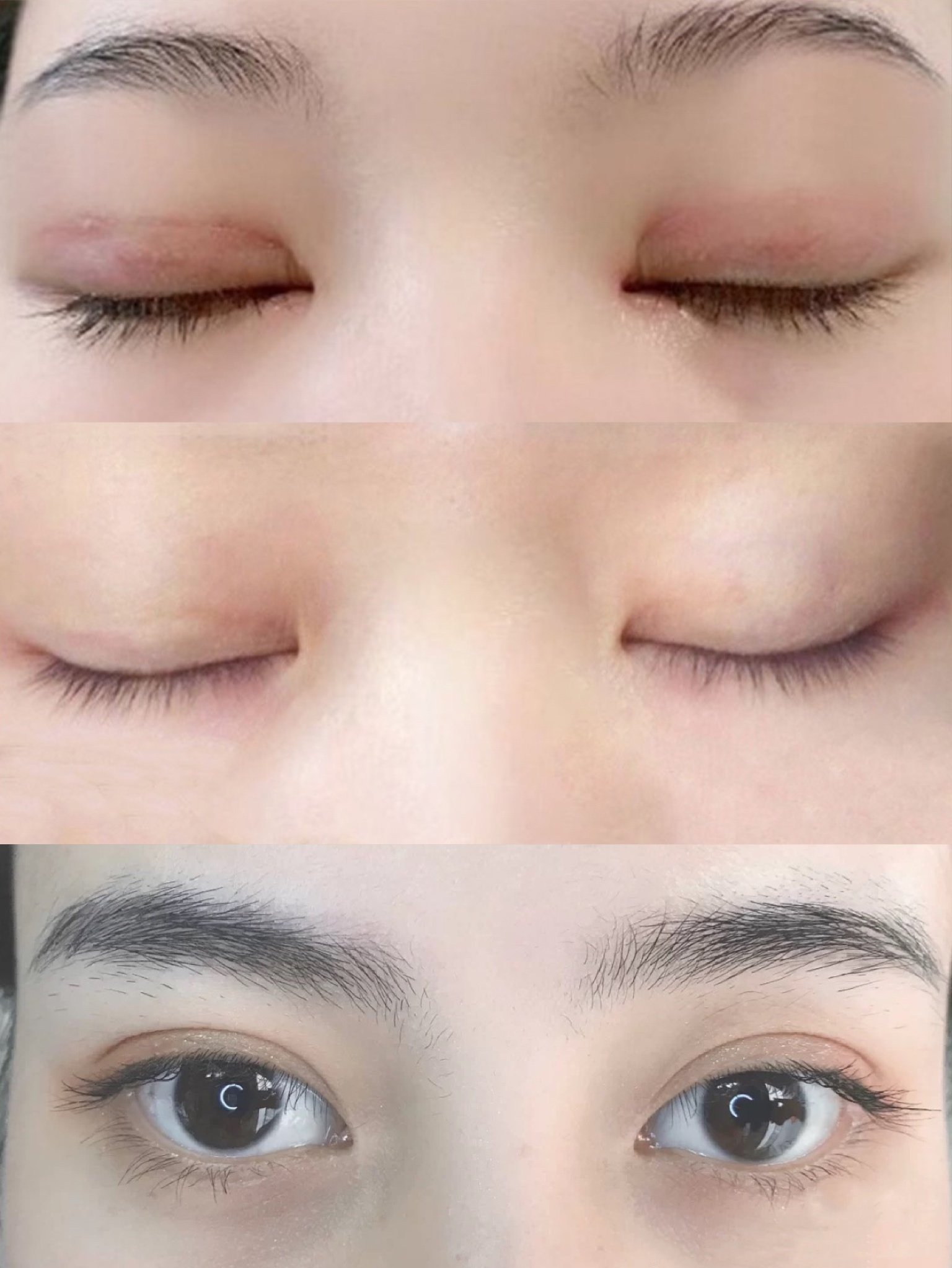 全切双眼皮!5个月分享