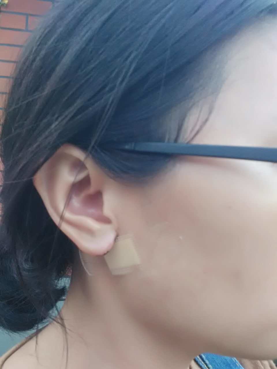 【成都渼淳玉颜】做完手术丰耳垂手术第五天
