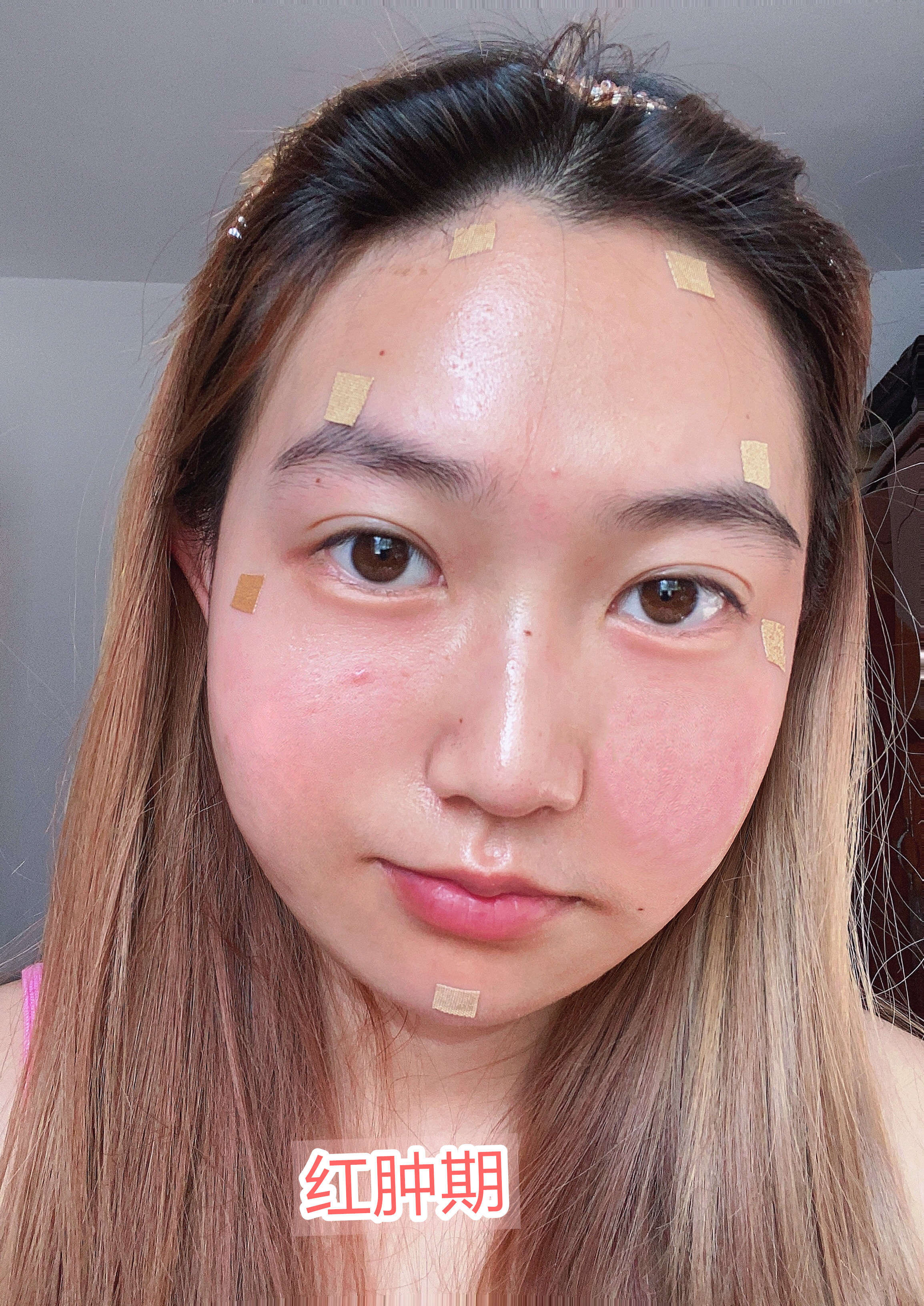 自体脂肪胶填充脸部后全部吸收_自体脂肪胶填充脸部可以维持多久_自体脂肪胶填充脸部可以维持多久