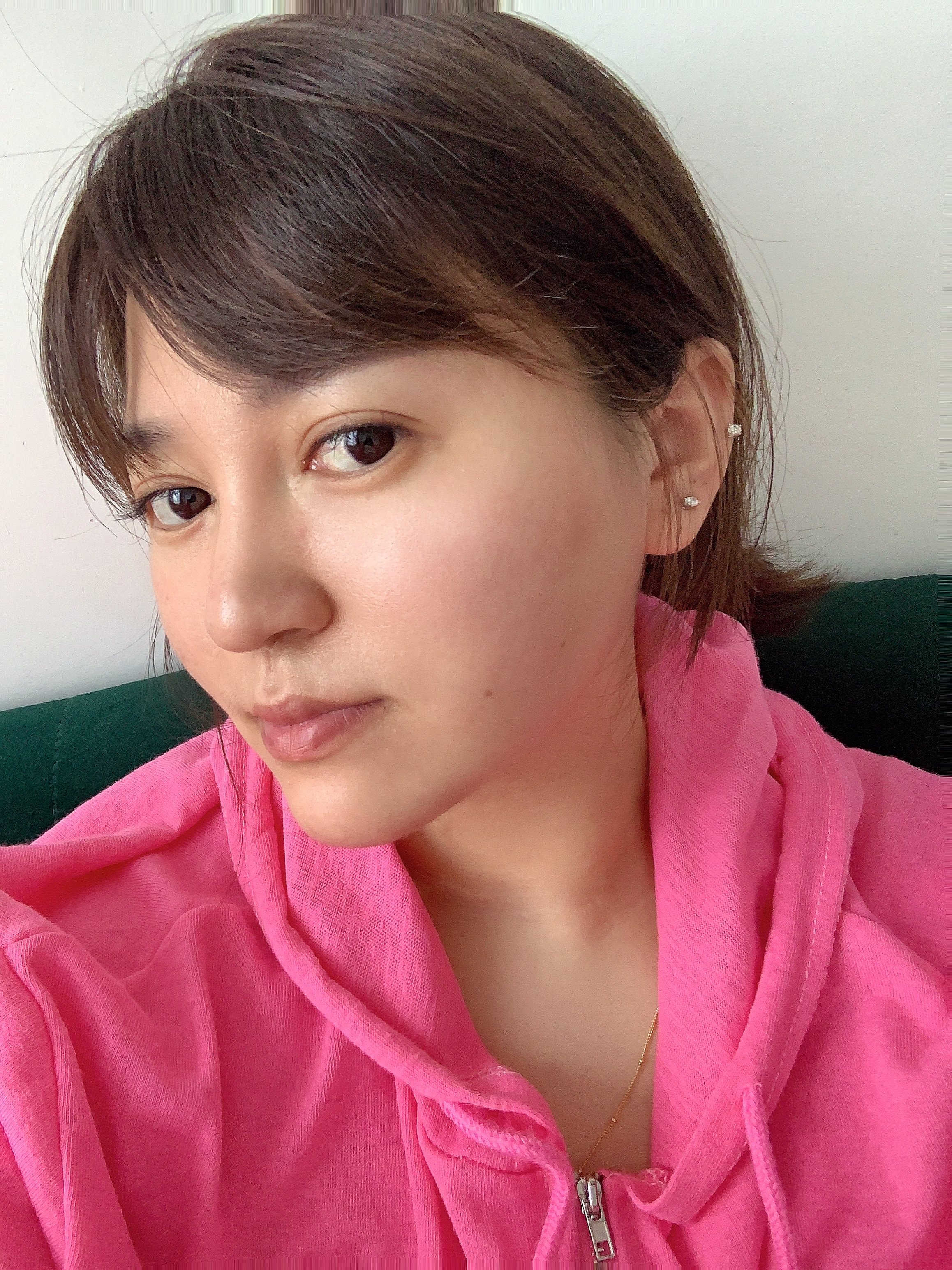 【吉林铭医整形】大v脸中下面部提拉线-术后