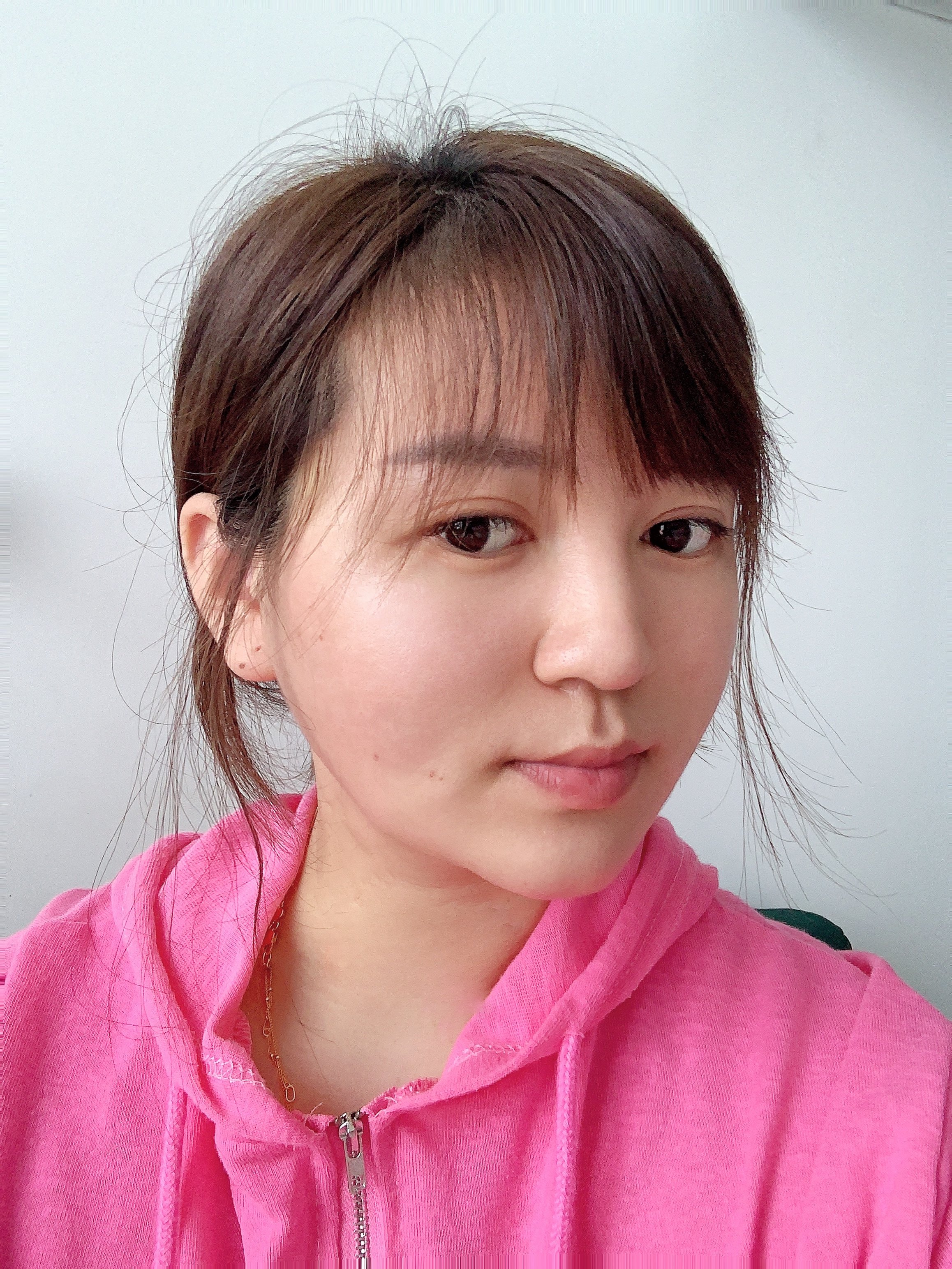 【吉林铭医整形】大v脸中下面部提拉线-术后