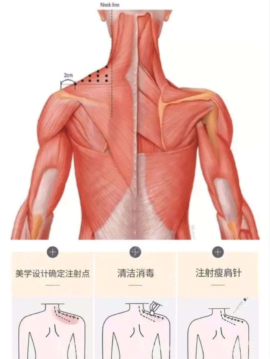 瘦肩针的打法和画点图片