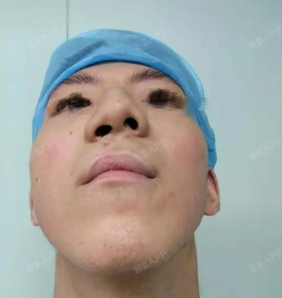 成年唇裂患者鼻畸形成功修复记录