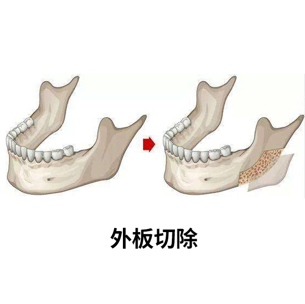 下颌骨外板切除因为可以正面收窄下半张脸,所以常配合下颌角截骨手术