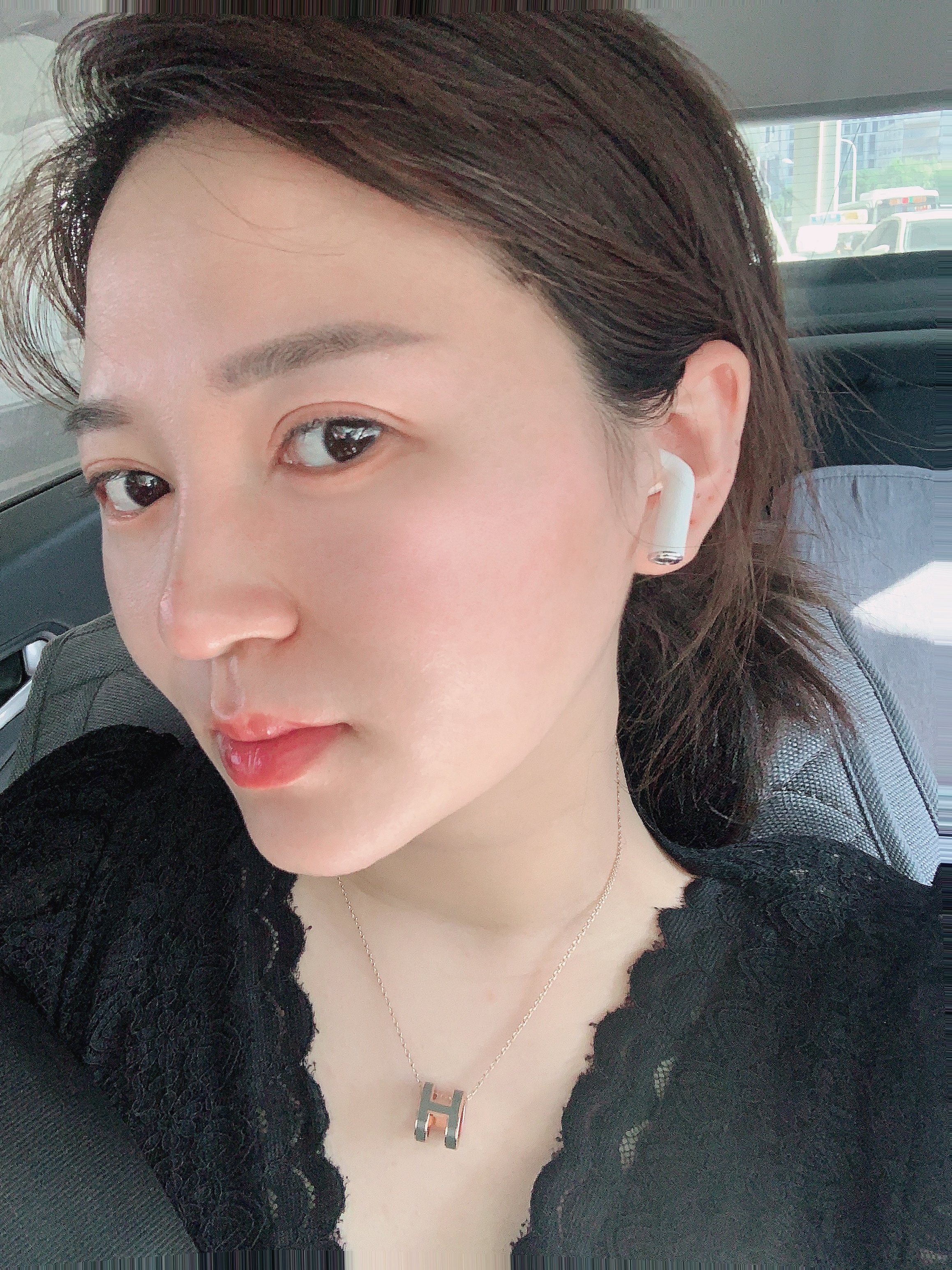 【吉林铭医整形】大v脸中下面部提拉线-术后5天