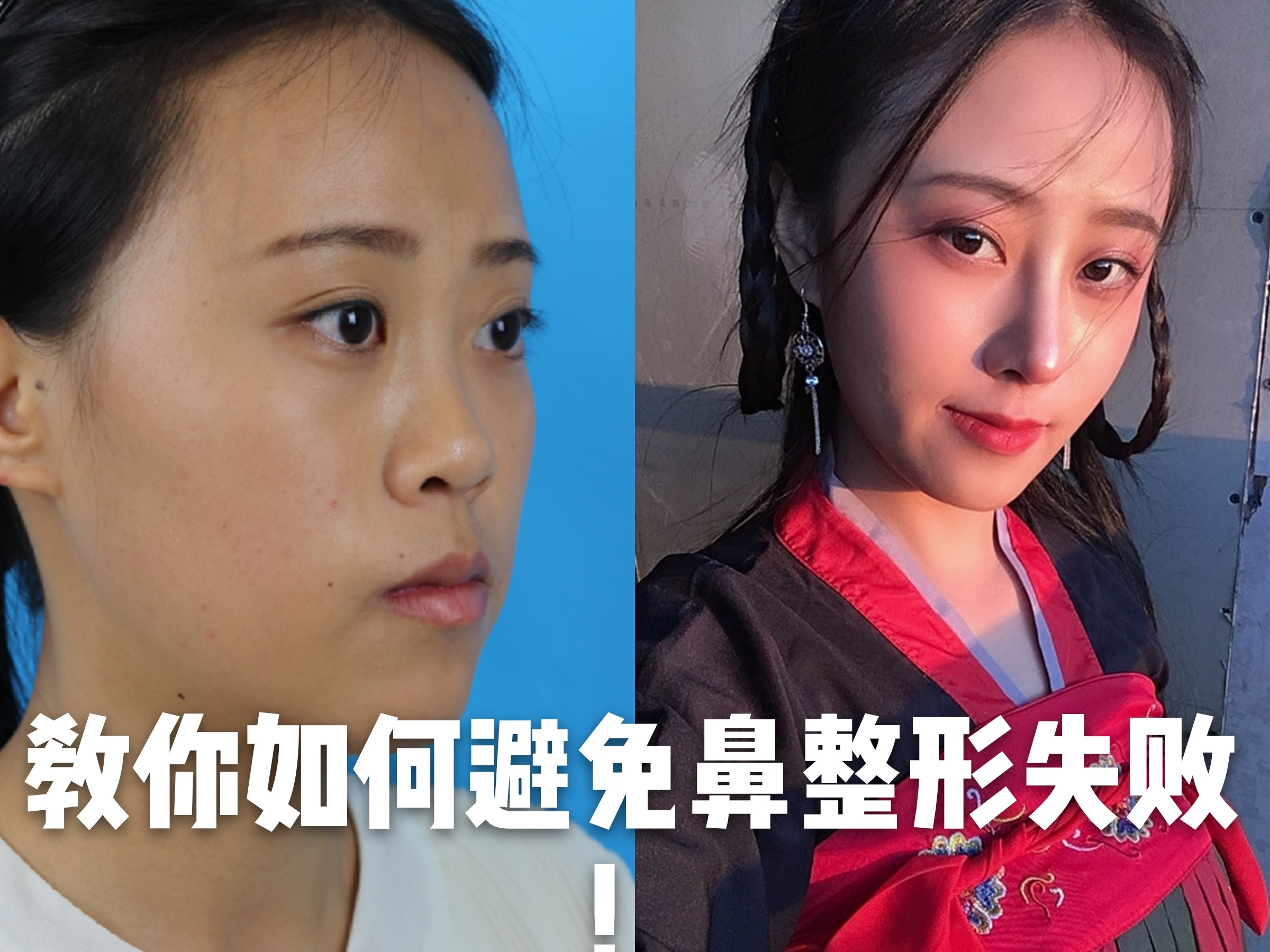 Before After征集4鼻整形一直 圈子 新氧美容整形