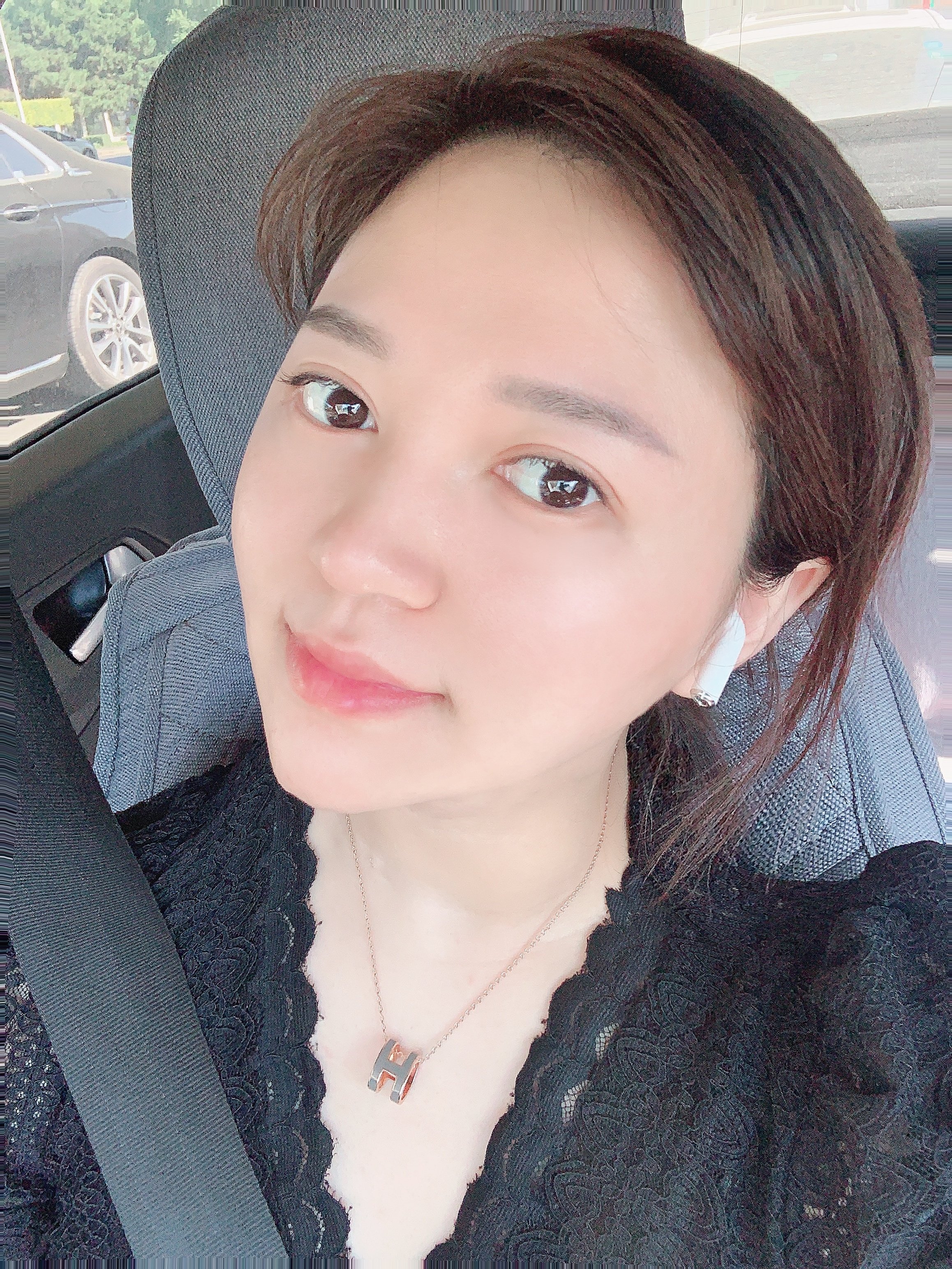 【吉林铭医整形】大v脸中下面部提拉线-术后5天