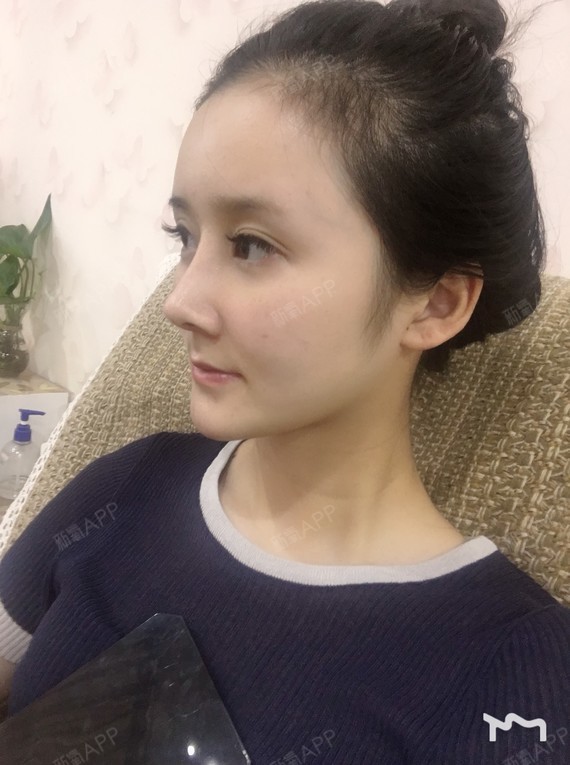 耳软骨鼻部多项15天了,现在鼻子一天比一天自然多_圈子-新氧美容整形