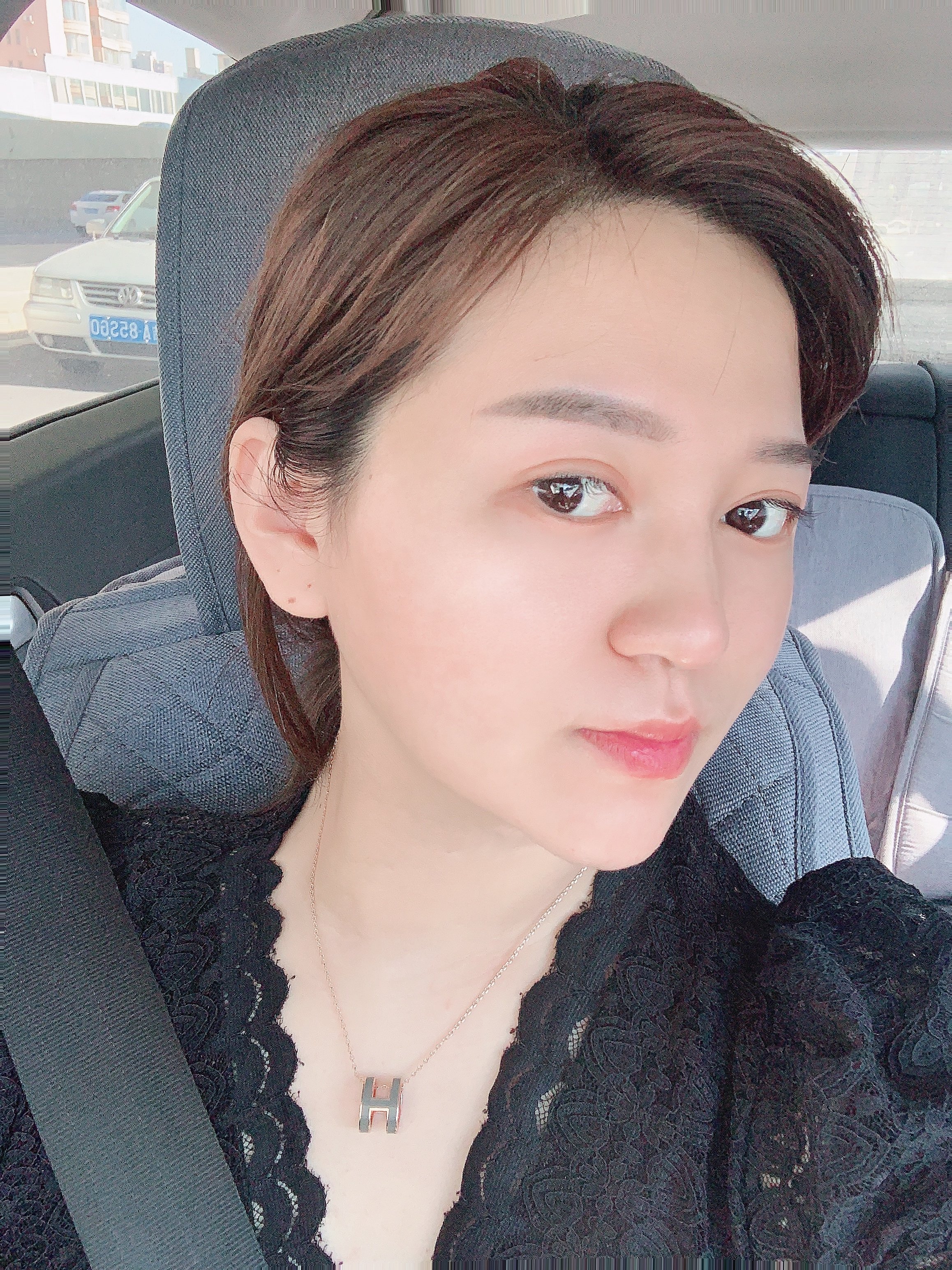 【吉林铭医整形】大v脸中下面部提拉线-术后5天