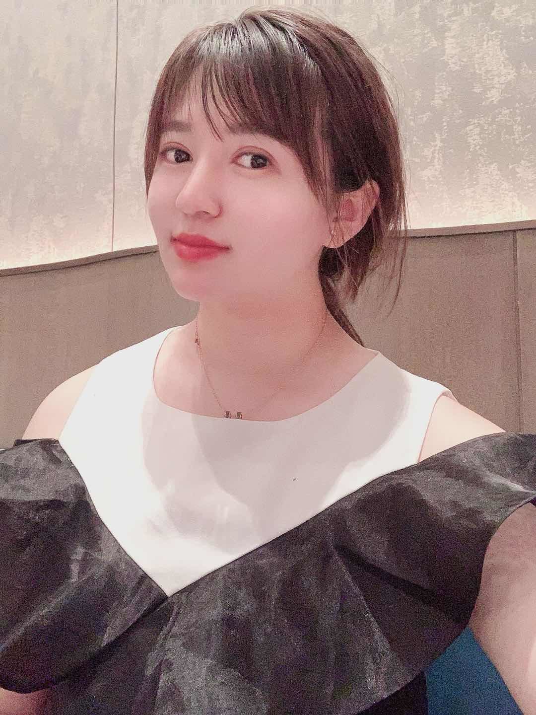 吉林铭医整形大v脸中下面部提拉线术后7天