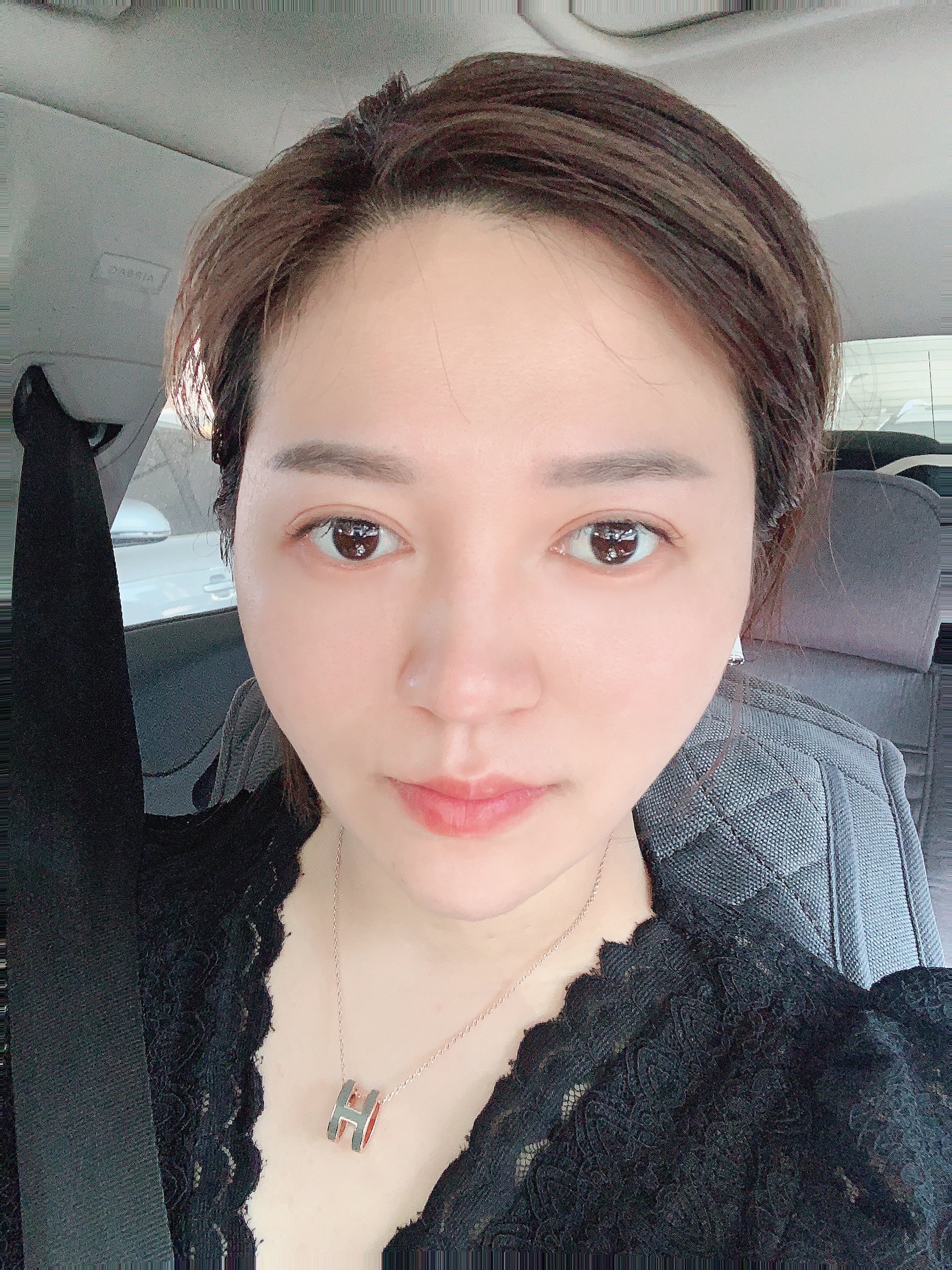 【吉林铭医整形】大v脸中下面部提拉线-术后5天