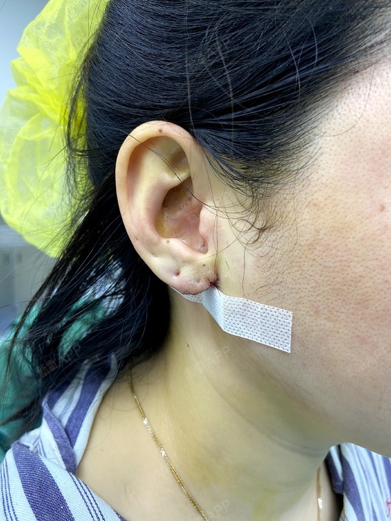 成都渼淳玉颜手术丰耳垂