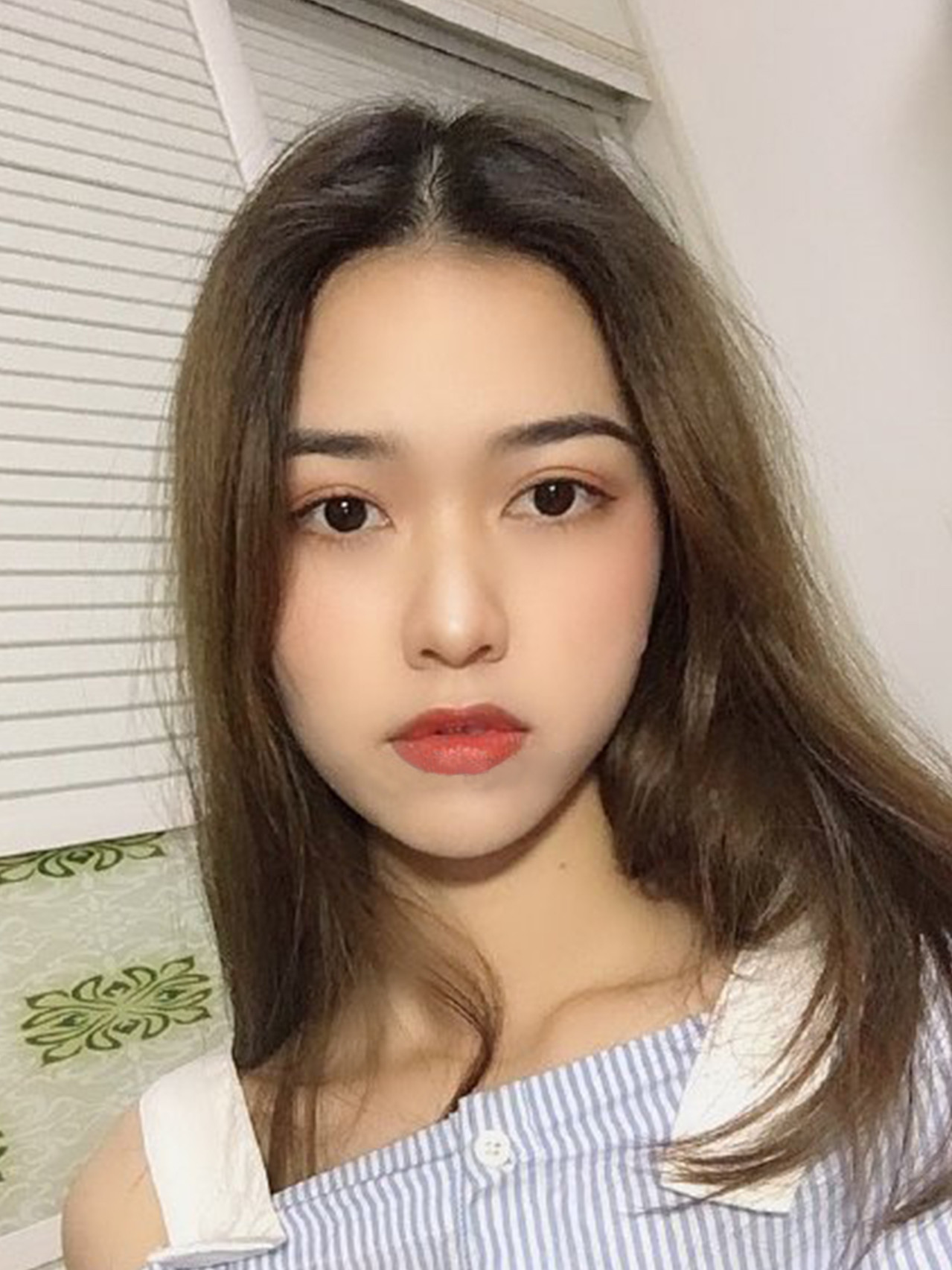 全切双眼皮 开眼角 , 很真实的恢复净经验分享!