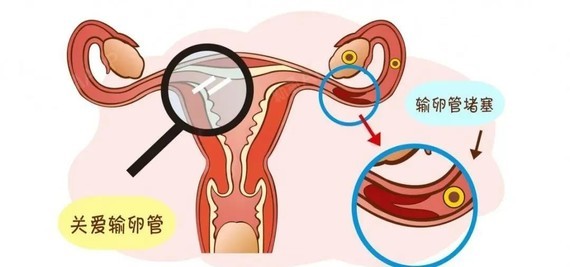 因为输卵管管腔比较细,炎症后易造成粘连堵塞