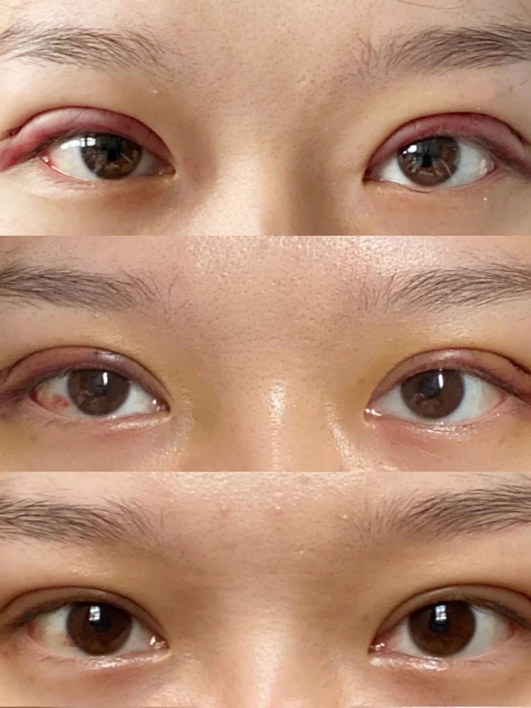 做的双眼皮能自然到什么程度
