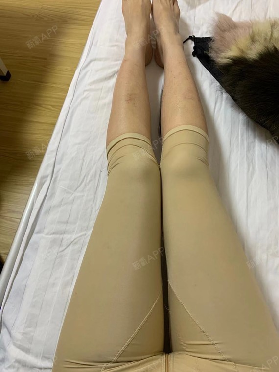 一,手术项目:大腿吸脂