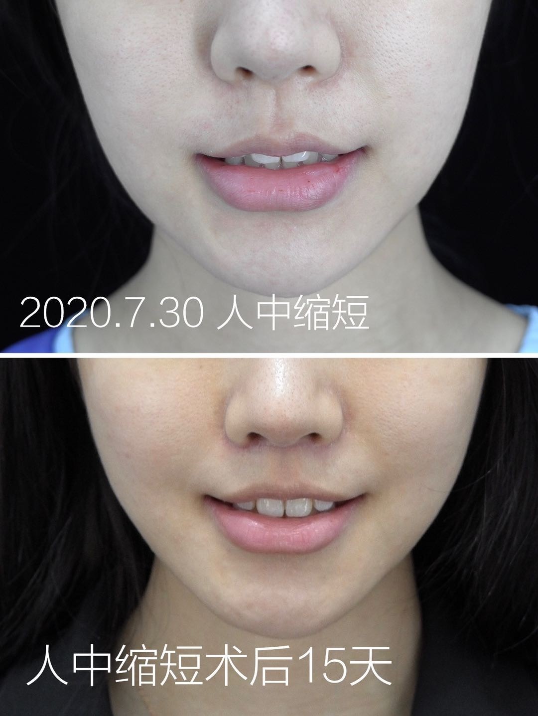 人中缩短术后第15天反馈啦