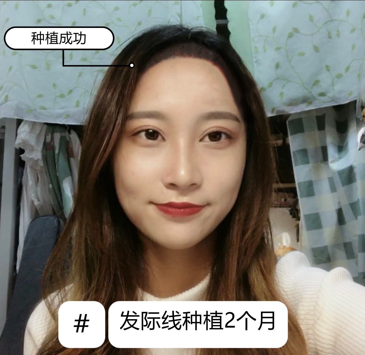 【深圳新生植发-发际线种植术后2个月】 植发两个月_圈子-新氧美容