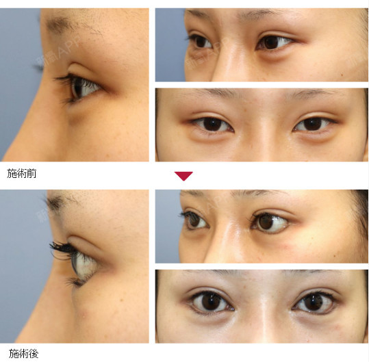 希望能够横向纵向全方位放大双眼,使眼睛变得明亮有神.