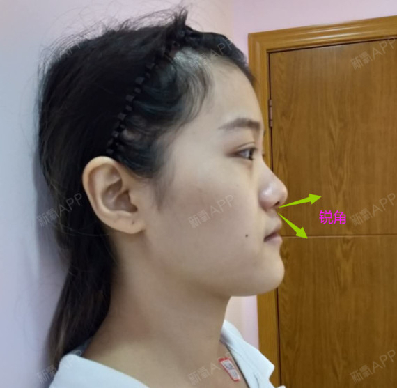 像这位做鼻子及脂肪填充的姑娘,鼻唇角成锐角,就是属于鼻基底凹陷的