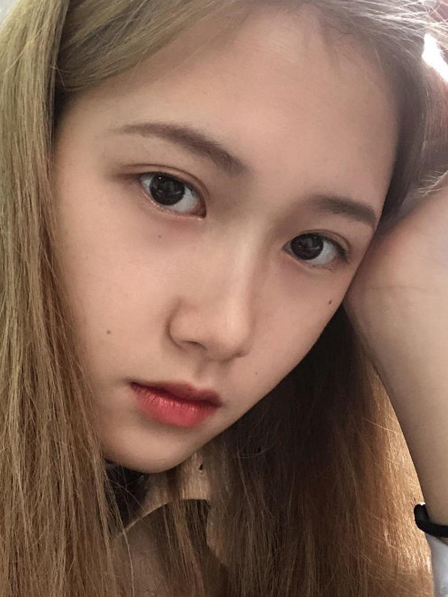 超满意的全切双眼皮自然就像天生的一样