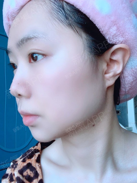 术后7天