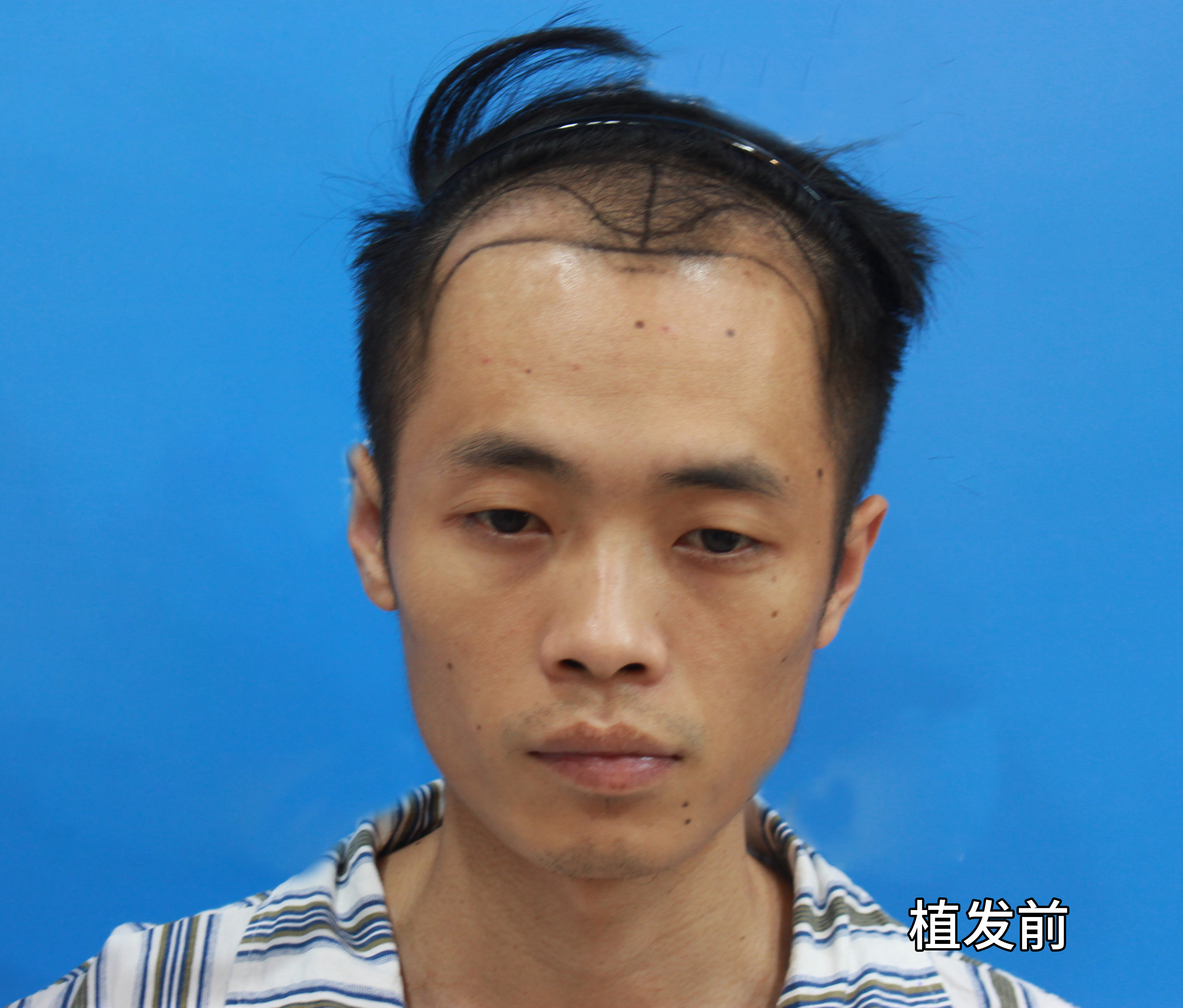 这位小伙植发3500单位后整个人都变了?