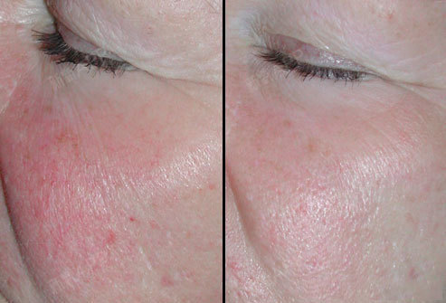 皮肤一冷一热就泛红可以做dpl光子改善吗?