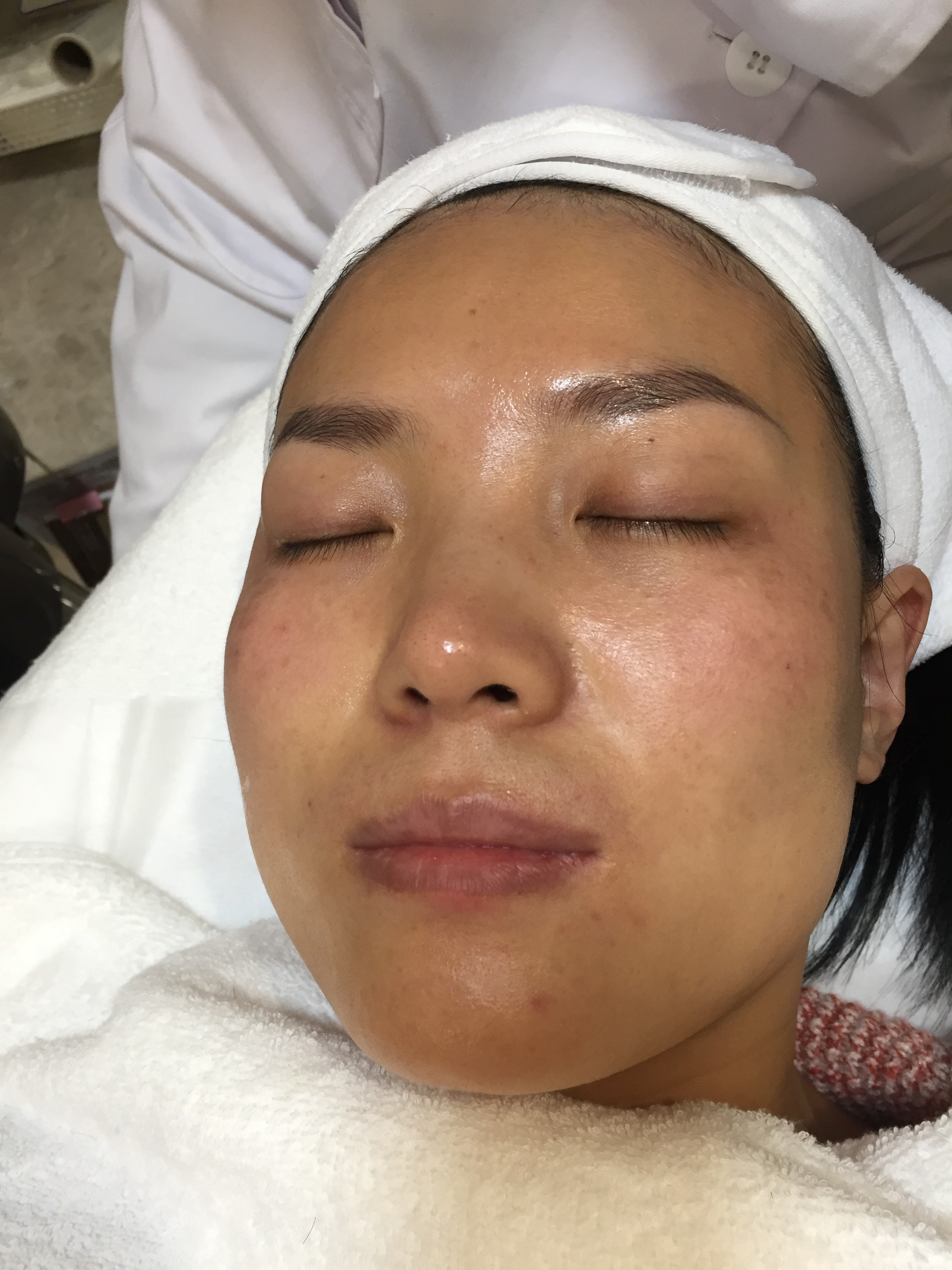 【华亦俏调q激光 光子嫩肤】祛斑中.