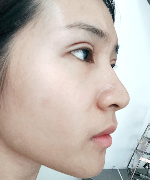 终于还是下定决心去割双眼皮了,今天第三天,不知道什_圈子-新氧美容